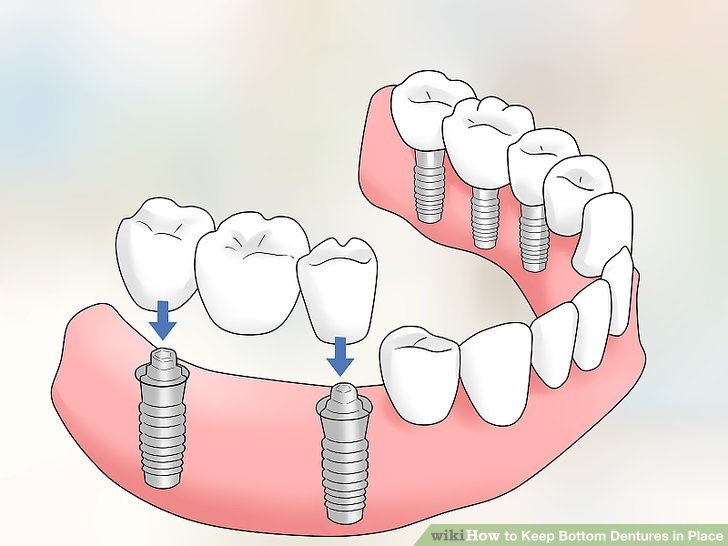 Jaw Registration For 
      Partial Dentures Gilead NE 68362